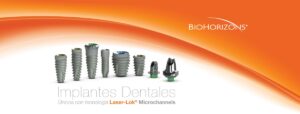 Biohorizons dental implants